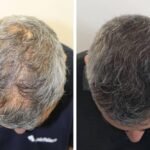 From Loss to Luxuriance: Discover Hair Transplants in London